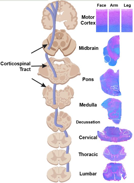 ALS upper motor neurons dying back
